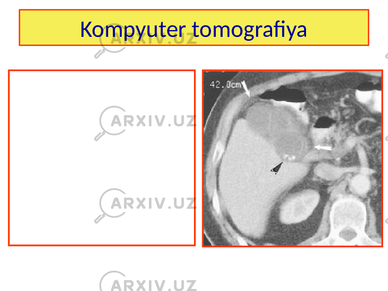 Kompyuter tomografiya 