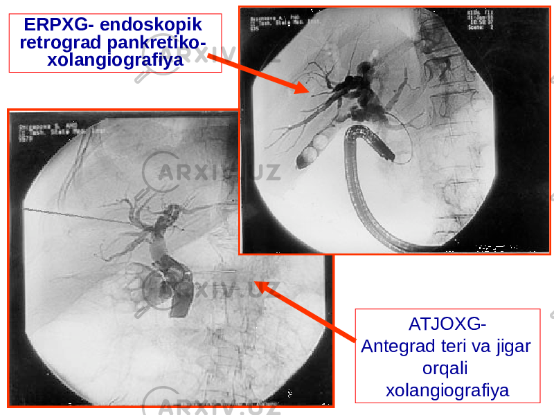 ERPXG- endoskopik retrograd pankretiko- xolangiografiya ATJOXG- Antegrad teri va jigar orqali xolangiografiya 