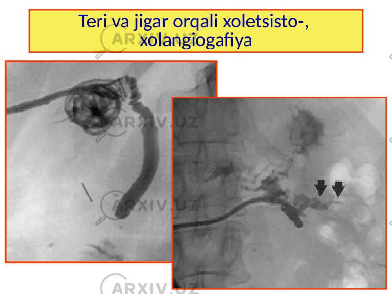 Teri va jigar orqali xoletsisto-, xolangiogafiya 