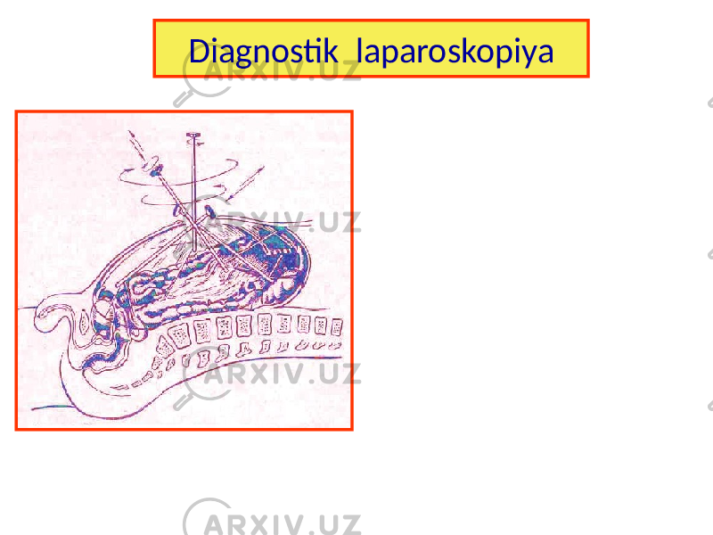 Diagnostik laparoskopiya 