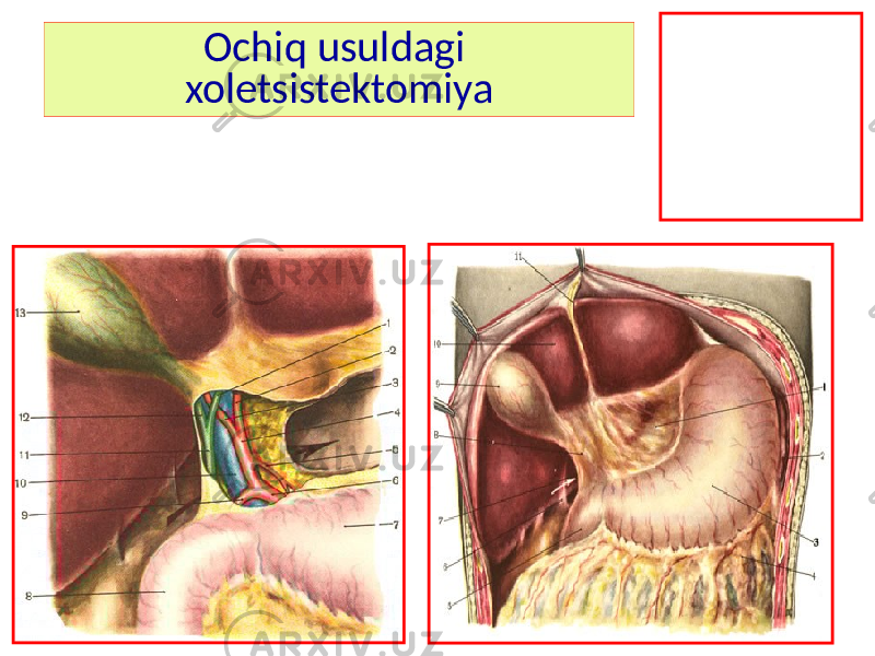 Ochiq usuldagi xoletsistektomiya 