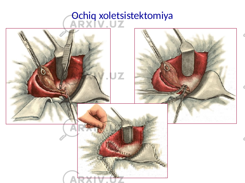 Ochiq xoletsistektomiya 