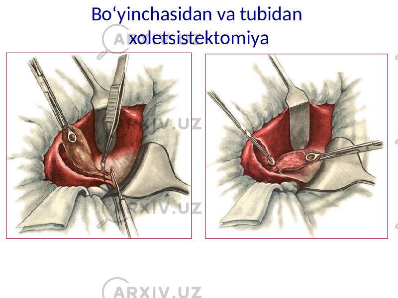 Bo‘yinchasidan va tubidan xoletsistektomiya 