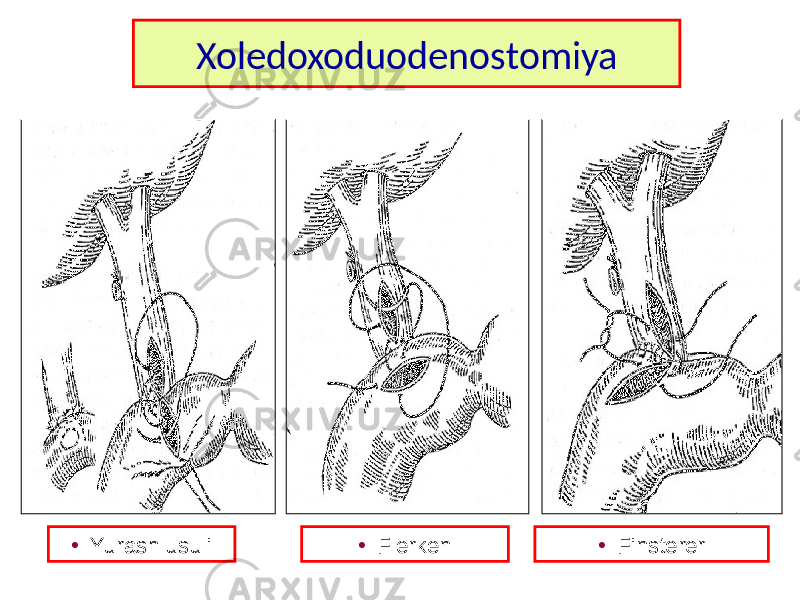 Xoledoxoduodenostomiya • Yurash usuli • Flerken • Finsterer 