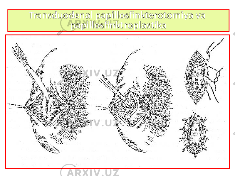 Transduodenal papillosfinkterotomiya va papillosfinktroplastika 