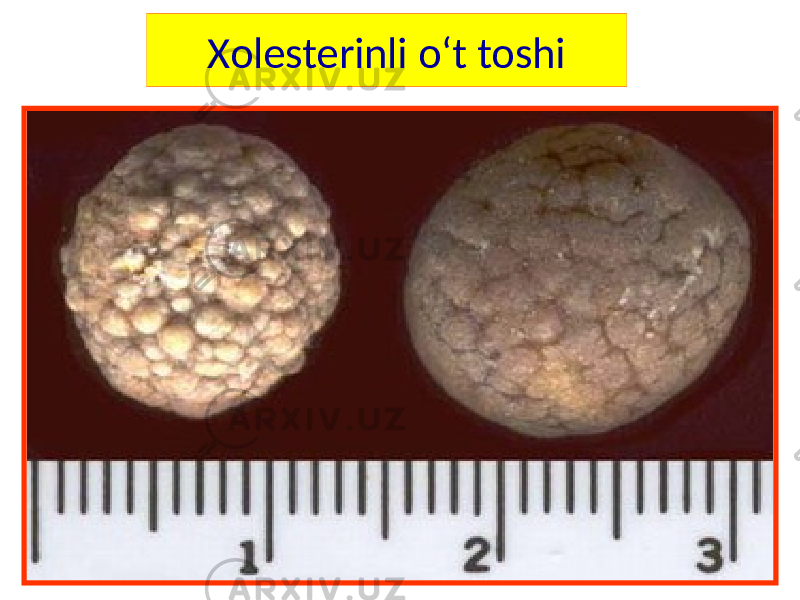 Xolesterinli o‘t toshi 