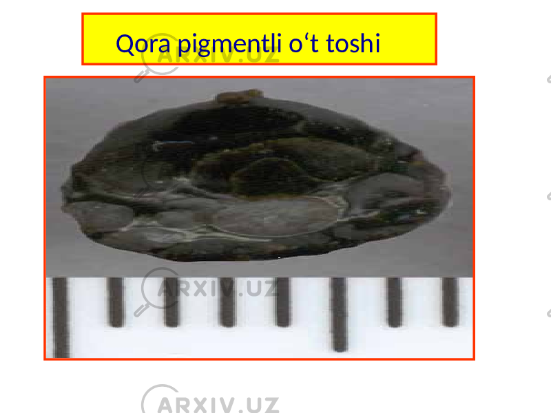 Qora pigmentli o‘t toshi   