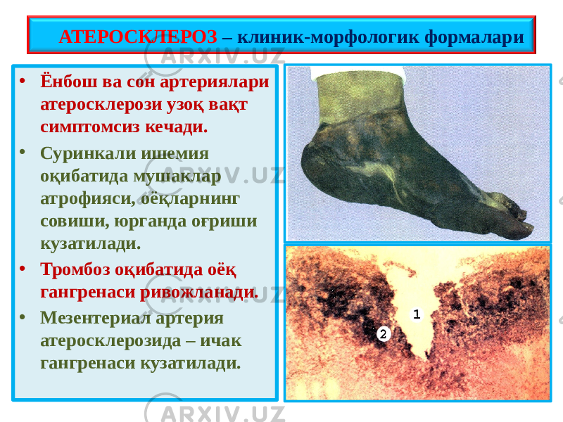 • Ёнбош ва сон артериялари атеросклерози узоқ вақт симптомсиз кечади. • Суринкали ишемия оқибатида мушаклар атрофияси, оёқларнинг совиши, юрганда оғриши кузатилади. • Тромбоз оқибатида оёқ гангренаси ривожланади. • Мезентериал артерия атеросклерозида – ичак гангренаси кузатилади. АТЕРОСКЛЕРОЗ – клиник-морфологик формалари 