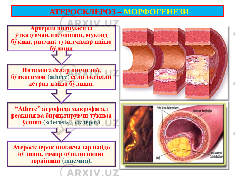  АТЕРОСКЛЕРОЗ – МОРФОГЕНЕЗИ 