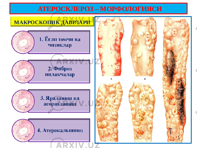 МАКРОСКОПИК ДАВРЛАРИ АТЕРОСКЛЕРОЗ – МОРФОЛОГИЯСИ 