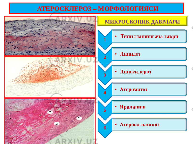 МИКРОСКОПИК ДАВРЛАРИ АТЕРОСКЛЕРОЗ – МОРФОЛОГИЯСИ 