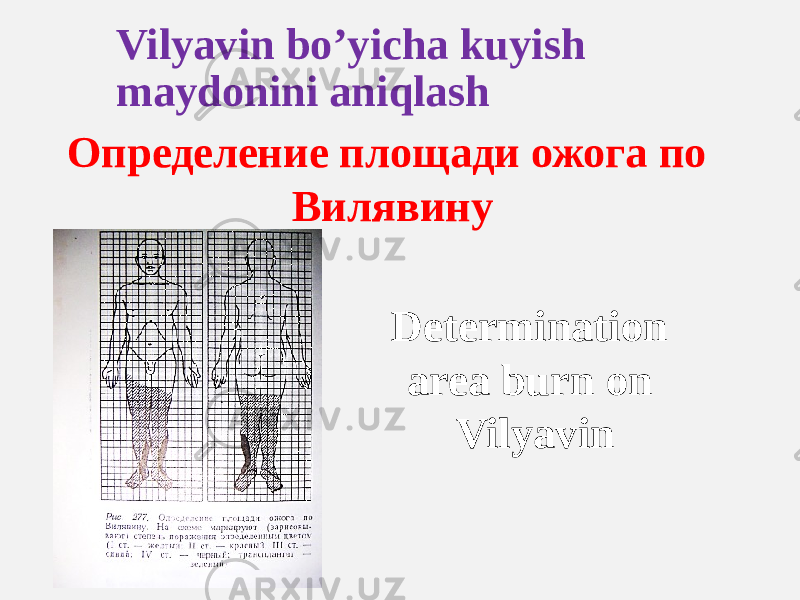 Vilyavin bo’yicha kuyish maydonini aniqlash Определение площади ожога по Вилявину Determination area burn on Vilyavin 