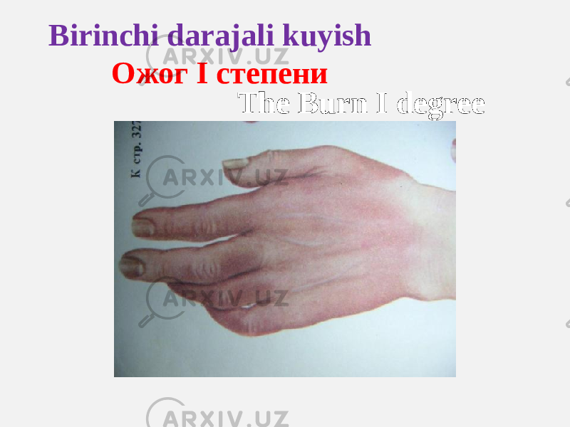 Birinchi darajali kuyish Ожог I степени The Burn I degree 