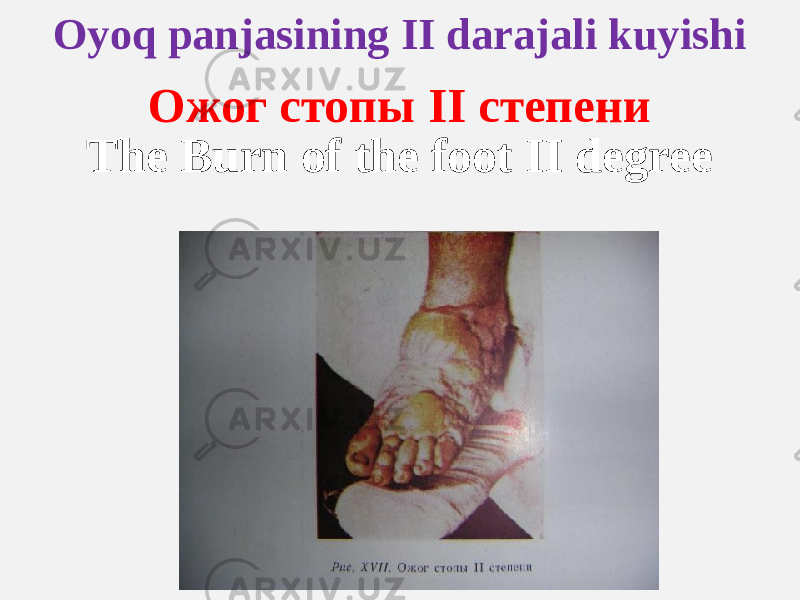 Oyoq panjasining II darajali kuyishi Ожог стопы II степени The Burn of the foot II degree 