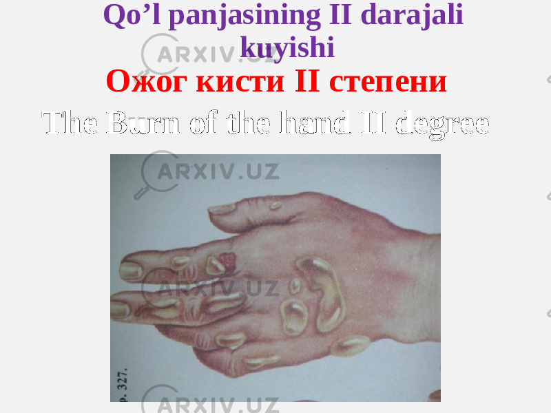 Qo’l panjasining II darajali kuyishi Ожог кисти II степени The Burn of the hand II degree 