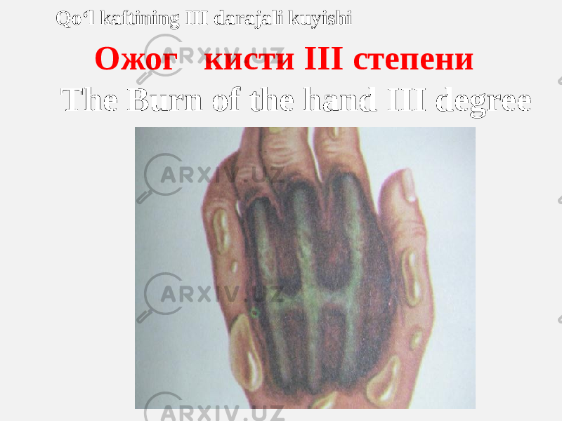  Qo‘l kaftining III darajali kuyishi Ожог кисти III степени The Burn of the hand III degree 