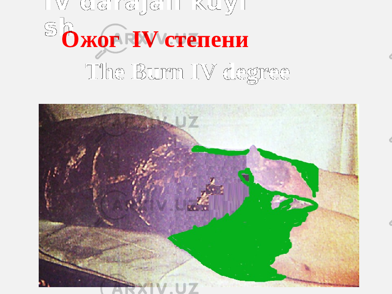 IV darajali kuyi sh Ожог IV степени The Burn IV degree 