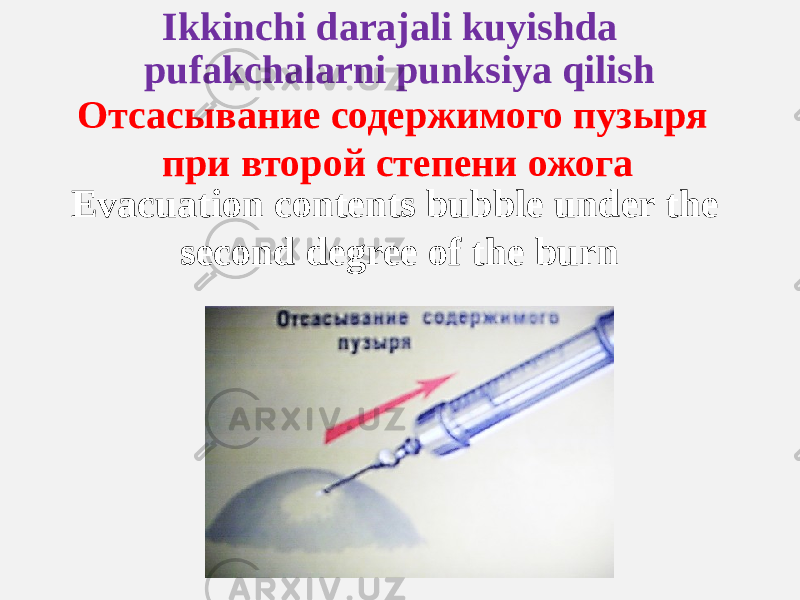 Ikkinchi darajali kuyishda pufakchalarni punksiya qilish Отсасывание содержимого пузыря при второй степени ожога Evacuation contents bubble under the second degree of the burn 