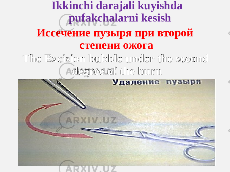 Ikkinchi darajali kuyishda pufakchalarni kesish Иссечение пузыря при второй степени ожога The Excision bubble under the second degree of the burn 