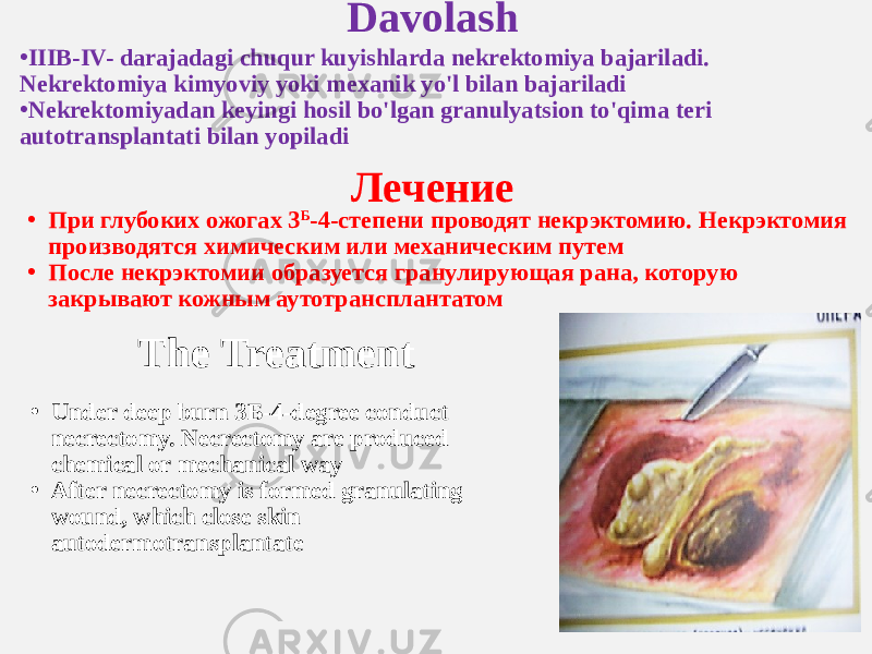• IIIB-IV- darajadagi chuqur kuyishlarda nekrektomiya bajariladi. Nekrektomiya kimyoviy yoki mexanik yo&#39;l bilan bajariladi • Nekrektomiyadan keyingi hosil bo&#39;lgan granulyatsion to&#39;qima teri autotransplantati bilan yopiladi Davolash Лечение The Treatment• При глубоких ожогах 3 Б -4-степени проводят некрэктомию. Некрэктомия производятся химическим или механическим путем • После некрэктомии образуется гранулирующая рана, которую закрывают кожным аутотрансплантатом • Under deep burn 3Б-4-degree conduct neсrectomy. Neсrectomy are produced chemical or mechanical way • After neсrectomy is formed granulating wound, which close skin autodermotransplantate 
