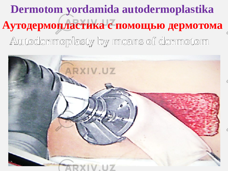 Dermotom yordamida autodermoplastika Аутодермопластика с помощью дермoтома Autodermoplasty by means of dermotom 