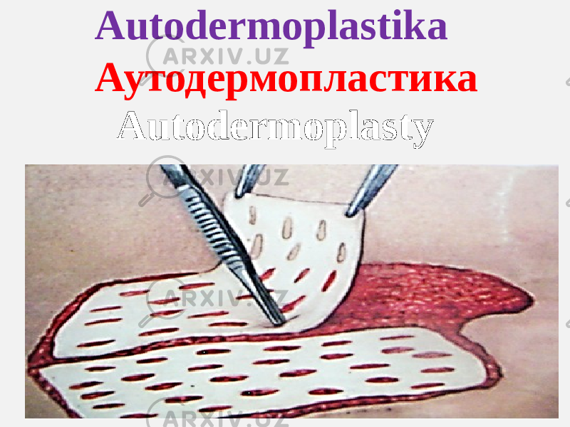 Autodermoplastika AutodermoplastyАутодермопластика 