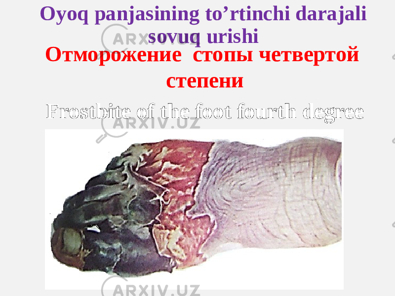 Oyoq panjasining to’rtinchi darajali sovuq urishi Отморожение стопы четвертой степени Frostbite of the foot fourth degree 