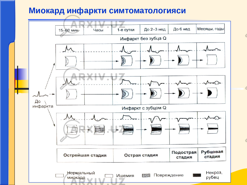 Миокард инфаркти симтоматологияси 