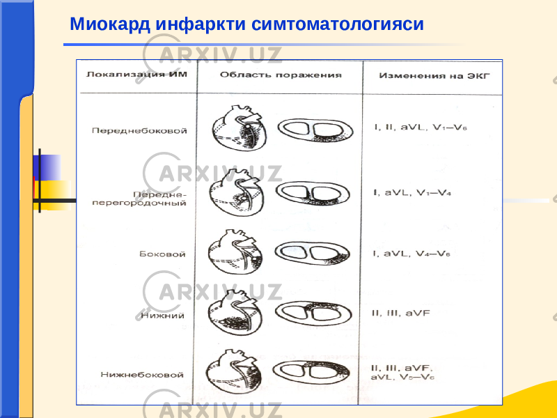  Миокард инфаркти симтоматологияси 