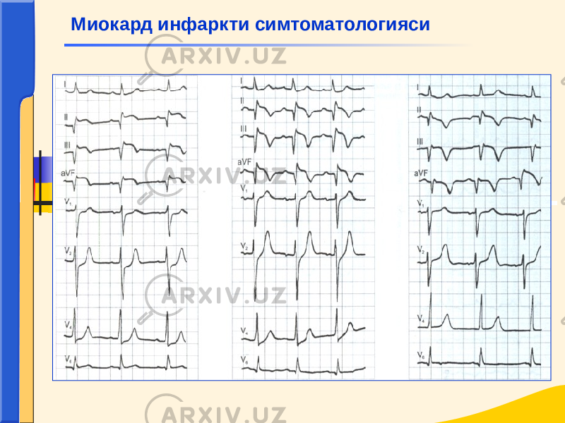  Миокард инфаркти симтоматологияси 