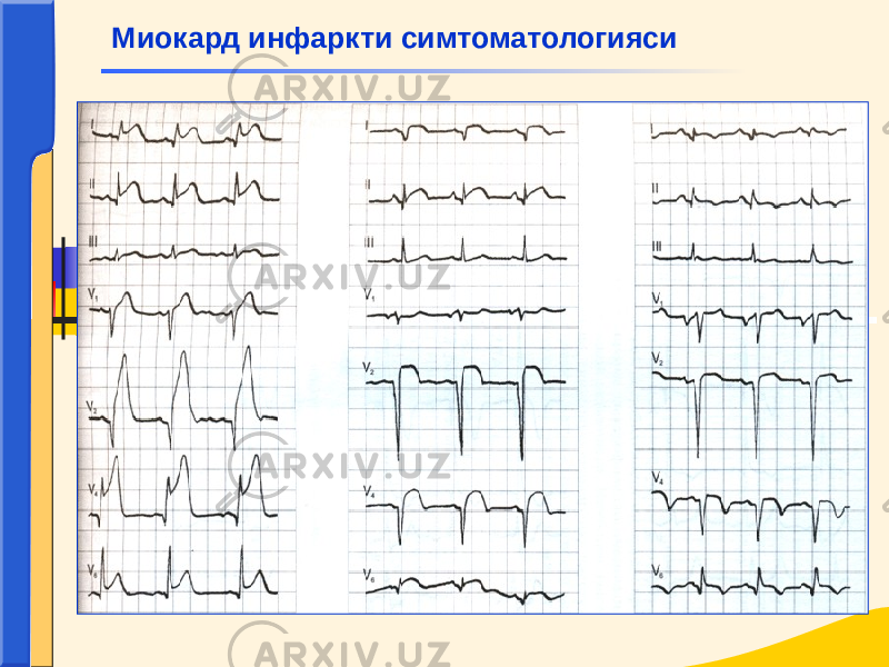  Миокард инфаркти симтоматологияси 