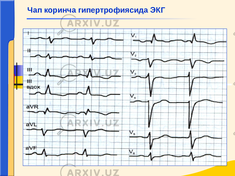 Чап коринча гипертрофиясида ЭКГ 