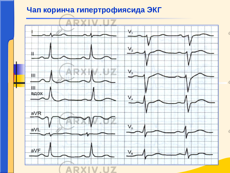 Чап коринча гипертрофиясида ЭКГ 