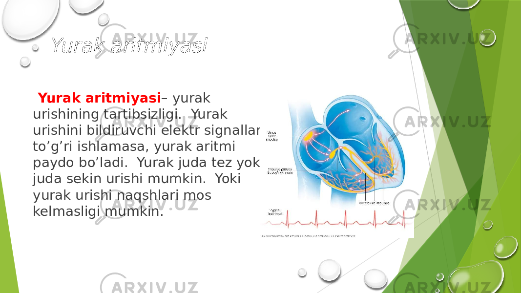 Yurak aritmiyasi Yurak aritmiyasi – yurak urishining tartibsizligi. Yurak urishini bildiruvchi elektr signallari to’g’ri ishlamasa, yurak aritmi paydo bo’ladi. Yurak juda tez yoki juda sekin urishi mumkin. Yoki yurak urishi naqshlari mos kelmasligi mumkin. 