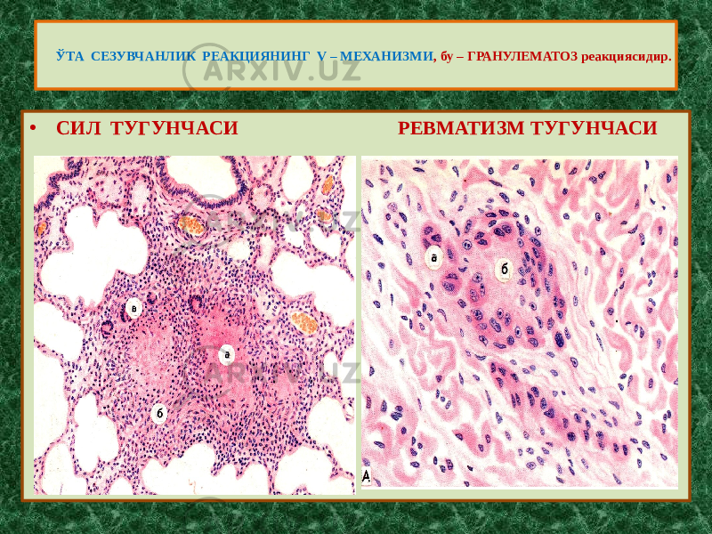 • СИЛ ТУГУНЧАСИ РЕВМАТИЗМ ТУГУНЧАСИ ЎТА СЕЗУВЧАНЛИК РЕАКЦИЯНИНГ V – МЕХАНИЗМИ , бу – ГРАНУЛЕМАТОЗ реакциясидир. 