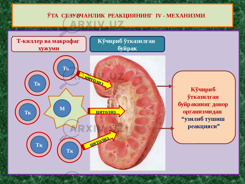 • ЎТА СЕЗУВЧАНЛИК РЕАКЦИЯНИНГ IV - МЕХАНИЗМИ Кўчириб ўтказилган буйракТ-киллер ва макрофаг хужуми Тк МТк Тк Тк Ткцитолиз цитолиз цитолиз Кўчириб ўтказилган буйракнинг донор организмидан “узилиб тушиш реакцияси” 