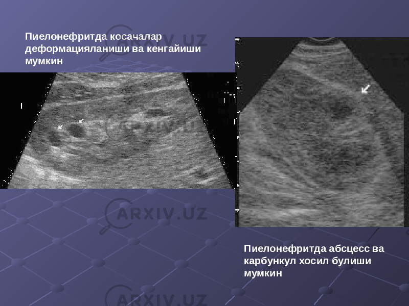 Пиелонефритда косачалар деформацияланиши ва кенгайиши мумкин Пиелонефритда абсцесс ва карбункул хосил булиши мумкин 