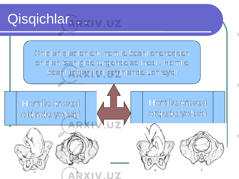 Qisqichlar. . . Chiqish qisqichlari- homila boshi chanoqdan chiqish teshigida turganda solinadi . Homila boshi tiqilish ikki ko’rinishda uchraydi Homila ensasi oldinda yotishi Homila ensasi orqada yotishi 