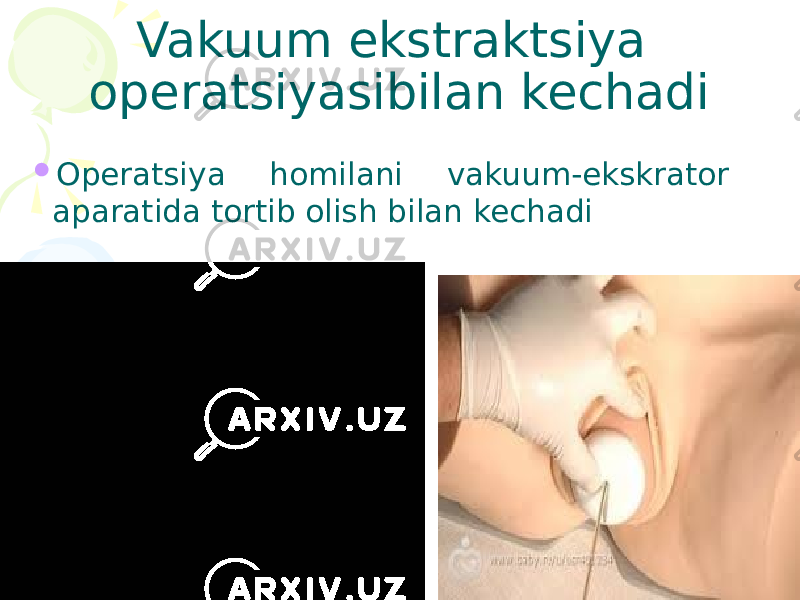 Vakuum ekstraktsiya operatsiyasibilan kechadi  Operatsiya homilani vakuum-ekskrator aparatida tortib olish bilan kechadi 