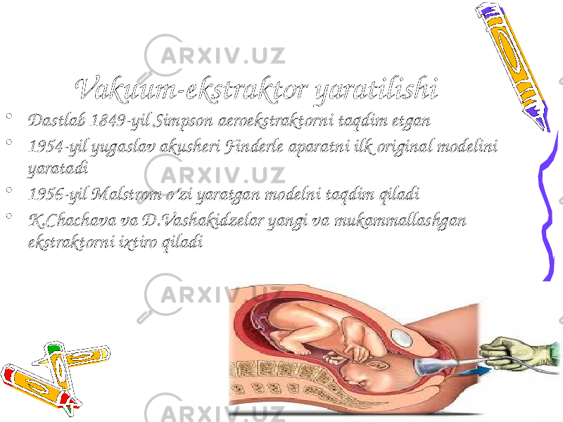 Vakuum-ekstraktor yaratilishi • Dastlab 1849-yil Simpson aeroekstraktorni taqdim etgan • 1954-yil yugaslav akusheri Finderle aparatni ilk original modelini yaratadi • 1956-yil Malstrom o’zi yaratgan modelni taqdim qiladi • K.Chachava va D.Vashakidzelar yangi va mukammallashgan ekstraktorni ixtiro qiladi 