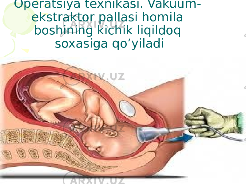 Operatsiya texnikasi. Vakuum- ekstraktor pallasi homila boshining kichik liqildoq soxasiga qo’yiladi 