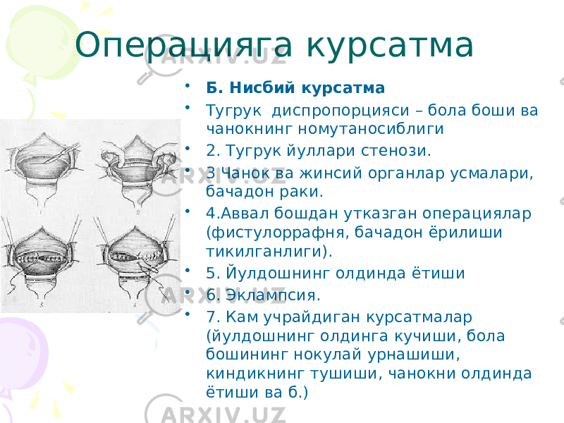 Операцияга курсатма • Б. Нисбий курсатма • Тугрук диспропорцияси – бола боши ва чанокнинг номутаносиблиги • 2. Тугрук йуллари стенози. • 3 Чанок ва жинсий органлар усмалари, бачадон раки. • 4.Аввал бошдан утказган операциялар (фистулоррафня, бачадон ёрилиши тикилганлиги). • 5. Йулдошнинг олдинда ётиши • 6. Эклампсия. • 7. Кам учрайдиган курсатмалар (йулдошнинг олдинга кучиши, бола бошининг нокулай урнашиши, киндикнинг тушиши, чанокни олдинда ётиши ва б.) 