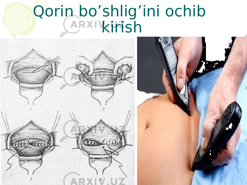 Qorin bo’shlig’ini ochib kirish 