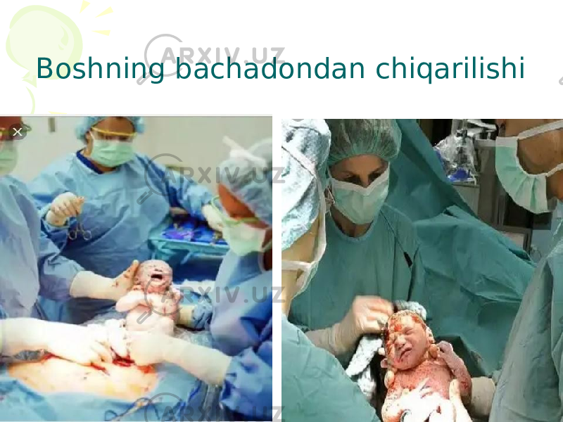 Boshning bachadondan chiqarilishi 