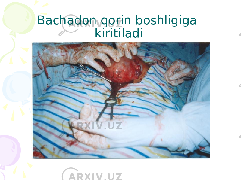 Bachadon qorin boshligiga kiritiladi 