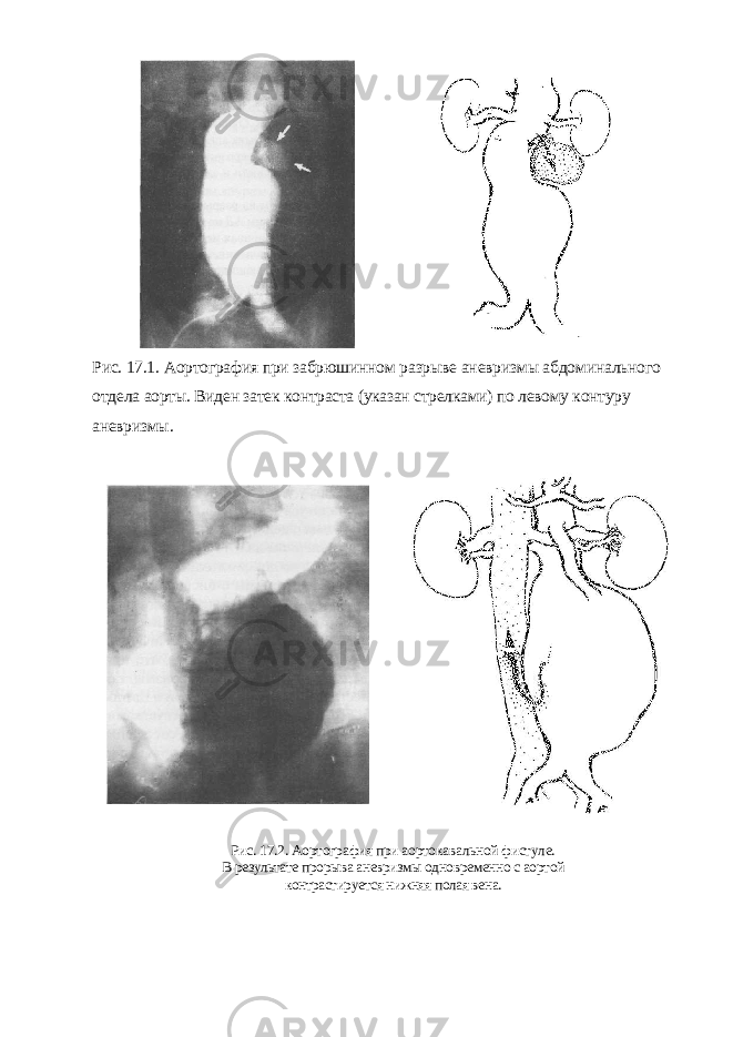 Рис. 17.1. Аортография при забрюшинном разрыве аневризмы абдоминального отдела аорты. Виден затек контраста (указан стрелками) по левому контуру аневризмы. Рис. 17.2. Аортография при аортокавальной фистуле. В результате прорыва аневризмы одновременно с аортой контрастируется нижняя полая вена. 