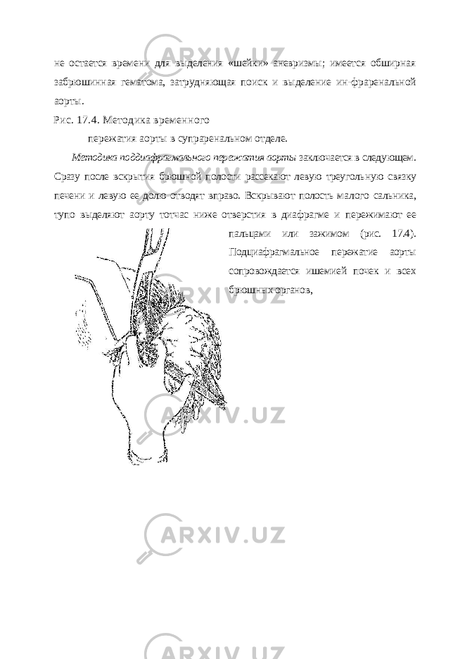 не остается времени для выделения «шейки» аневризмы; имеется обширная забрюшинная гематома, затрудняющая поиск и выделение ин- фраренальной аорты. Рис. 17.4. Методика временного пережатия аорты в супраренальном отделе. Методика поддиафрагмального пережатия аорты заключается в следу ющем. Сразу после вскрытия брюшной полости рассекают левую треуголь ную связку печени и левую ее долю отводят вправо. Вскрывают полость ма лого сальника, тупо выделяют аорту тотчас ниже отверстия в диафрагме и пережимают ее пальцами или зажимом (рис. 17.4). Подциафрагмальное пе режатие аорты сопровождается ишемией почек и всех брюшных органов, 