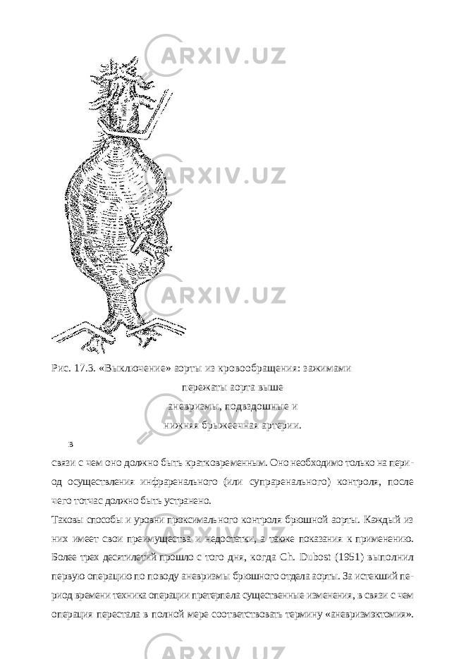 Рис. 17.3. «Выключение» аорты из кровообращения: зажимами пережаты аорта выше аневризмы, подвздошные и нижняя брыжеечная артерии. в связи с чем оно должно быть кратковре менным. Оно необходимо только на пери - од осуществления инфраренального (или супраренального) контроля, после чего тотчас должно быть устранено. Таковы способы и уровни проксималь ного контроля брюшной аорты. Каждый из них имеет свои преимущества и недо статки, а также показания к применению. Более трех десятилетий прошло с того дня, когда Ch . Dubost (1951) выполнил первую операцию по поводу аневризмы брюшного отдела аорты. За истекший пе - риод времени техника операции претерпе ла существенные изменения, в связи с чем операция перестала в полной мере соот ветствовать термину «аневризмэктомия». 
