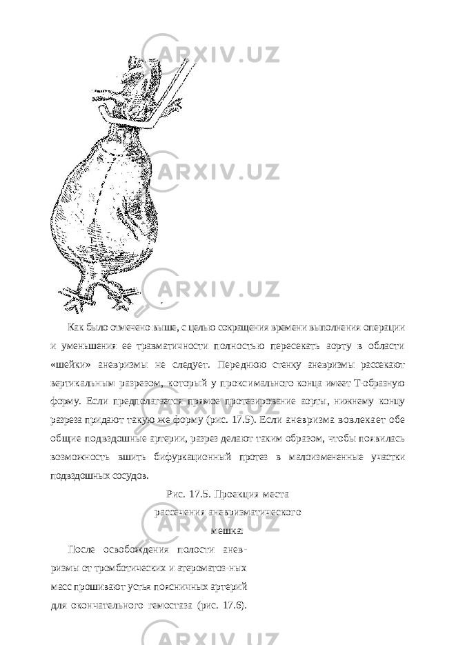 Как было отмечено выше, с целью сокращения времени выполнения опе рации и уменьшения ее травматичности полностью пересекать аорту в области «шейки» аневризмы не следует. Пере днюю стенку аневризмы рассекают верти кальным разрезом, который у прокси мального конца имеет Т-образную форму. Если предполагается прямое протезиро вание аорты, нижнему концу разреза при дают такую же форму (рис. 17.5). Если аневризма вовлекает обе общие под вздошные артерии, разрез делают таким образом, чтобы появилась возможность вшить бифуркационный протез в малоиз мененные участки подвздошных сосудов. Рис. 17.5. Проекция места рассечения аневризматического мешка. После освобождения полости анев - ризмы от тромботических и атероматоз- ных масс прошивают устья поясничных артерий для окончательного гемостаза (рис. 17.6). 