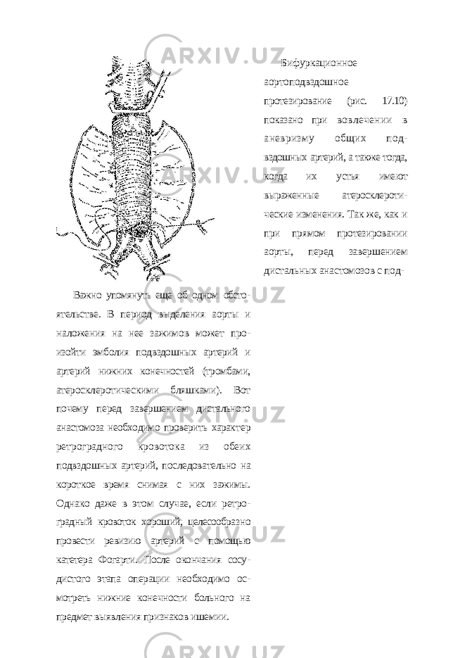 Важно упомянуть еще об одном обсто - ятельстве. В период выделения аорты и наложения на нее зажимов может про - изойти эмболия подвздошных артерий и артерий нижних конечностей (тромбами, атеросклеротическими бляшками). Вот почему перед завершением дистального анастомоза необходимо проверить харак тер ретроградного кровотока из обеих подвздошных артерий, последовательно на короткое время снимая с них зажимы. Однако даже в этом случае, если ретро - градный кровоток хороший, целесообраз но провести ревизию артерий с помощью катетера Фогарти. После окончания сосу - дистого этапа операции необходимо ос - мотреть нижние конечности больного на предмет выявления признаков ишемии. Бифуркационное аортоподвздошное протезирование (рис. 17.10) показано при вовлечении в аневризму общих под - вздошных артерий, а также тогда, когда их устья имеют выраженные атеросклероти- ческие изменения. Так же, как и при пря мом протезировании аорты, перед завер шением дистальных анастомозов с под- 